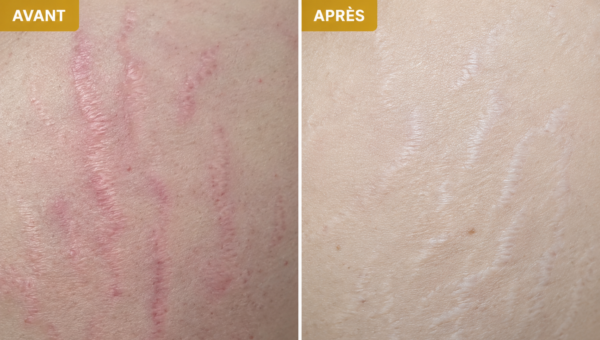 Soin Vergeture