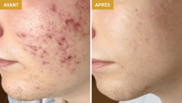 séance acné soins dermato-esthétique