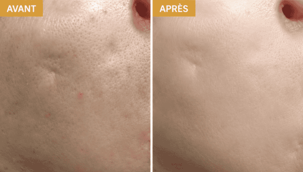 séance soins dermato-esthétique cicatrice
