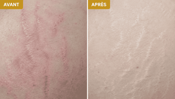 séance vergeture soins dermato-esthétique