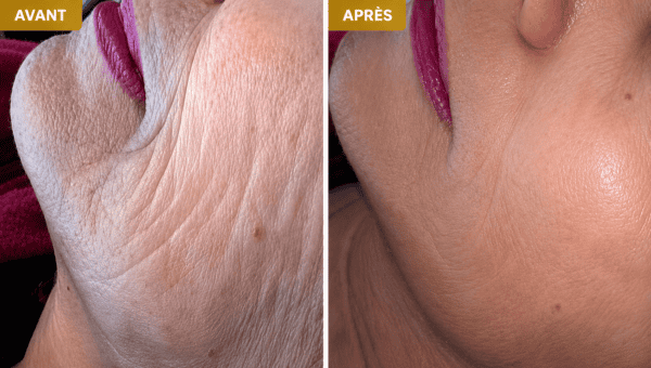 séance ride soins dermato-esthétique